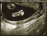 3rd Ultrasound 01